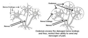Oedemas Encase Nerve Endings and Pain Stops